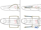 Dynamic external traction of a multifragmentary articular fracture of the middle phalangeal base
