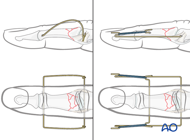 Dynamic external fixation: Suzuki type fixator frame allows early mobilization for multifragmentary articular fractures.