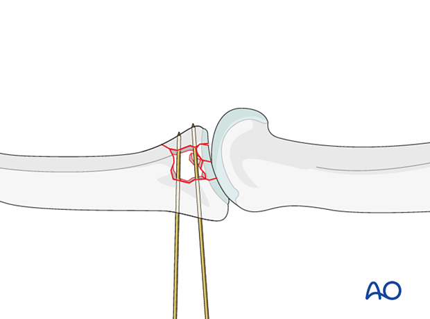 Dynamic external fixation: Insert K-wires from dorsal to palmar to stabilize articular fragments until fracture consolidation.