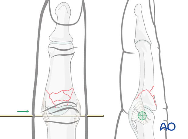Dynamic external fixation: Insert first 1.2 mm K-wire in center of rotation of proximal phalangeal condylar block under image intensification.