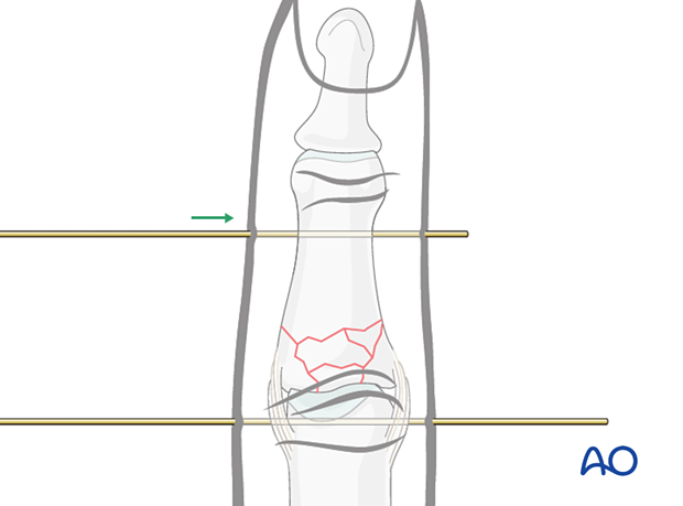 Dynamic external fixation: Insert second K-wire distal to fracture up to condyles of middle phalanx parallel to first K-wire.