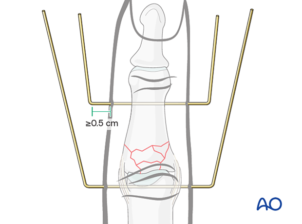 Dynamic external fixation: Bend both K-wires in a U-shape, leaving at least 0.5 cm between first bend and skin.