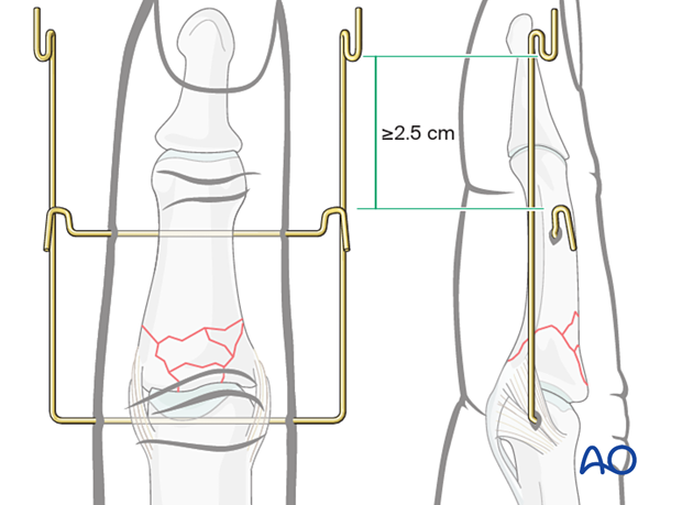 Dynamic external fixation: Create hooks, open proximally, on each end of second K-wire close to skin insertion; hooks on first K-wire 2.5 cm distal.