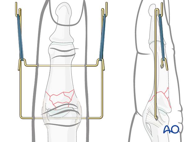Dynamic external fixation: This setup allows for distraction using dental rubber bands.