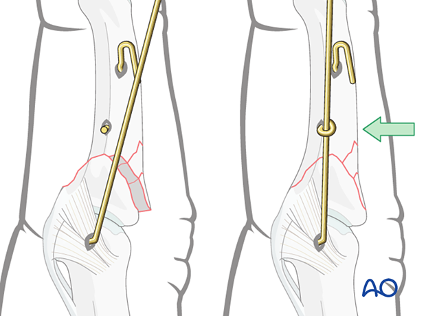 Dynamic external fixation: Insert third 1.0 mm K-wire in middle phalanx to control dorsal dislocation forces on PIP joint.
