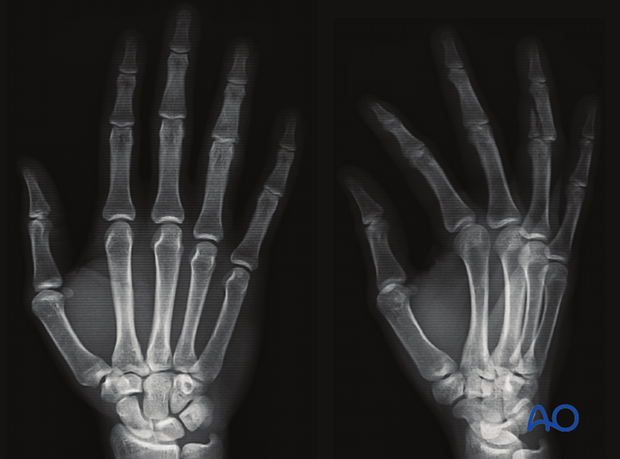 Joint reconstruction of palmar impaction fracture, multifragmentary fracture of 4th middle phalanx, AP and oblique views.