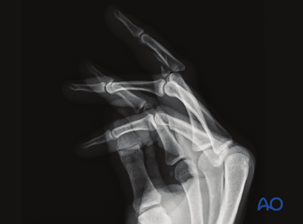 Joint reconstruction of palmar impaction fracture, multifragmentary fracture of 4th middle phalanx, lateral x-ray.