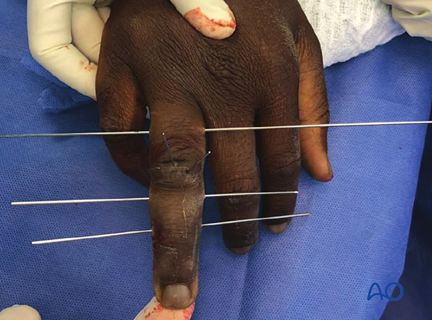 Joint reconstruction of palmar impaction fracture, K-wires inserted for fragment stabilization and dynamic external fixation.
