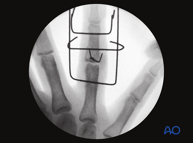 Joint reconstruction of palmar impaction fracture, AP view of final construct with K-wire stabilization of fragments.