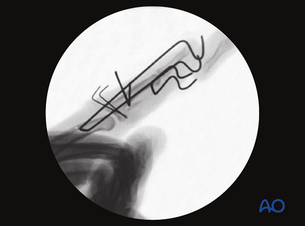 Joint reconstruction of palmar impaction fracture, lateral view of final construct with K-wire stabilization.