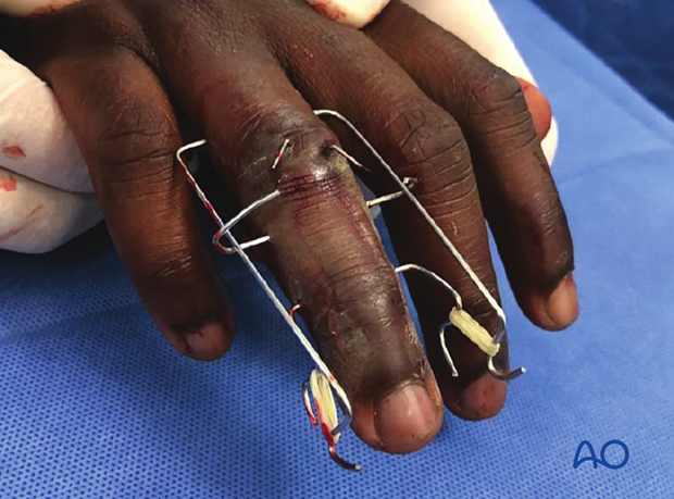 Joint reconstruction of palmar impaction fracture, postoperative image of final construct.