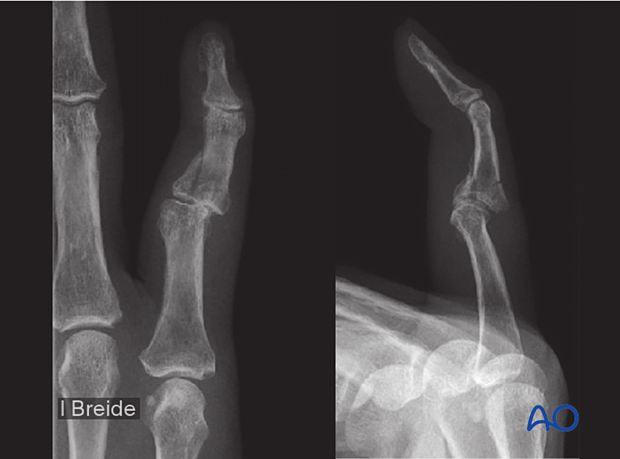 Dynamic external fixation of a multifragmentary complete articular fracture of the middle phalangeal base.