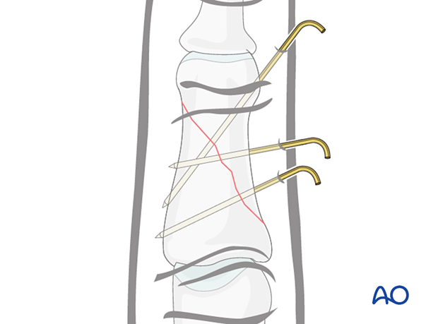 K-wire fixation of middle phalangeal shaft fracture, optimal for pediatric patients, showing wire insertion and stabilization.