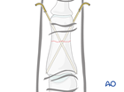 K wire fixation of a transverse fracture of the middle phalanx