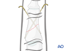 K-wire fixation of an oblique fracture of the middle phalanx