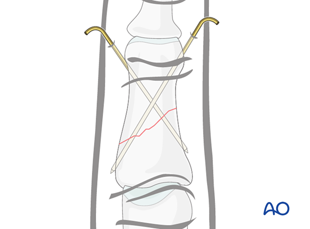 K-wire fixation of middle phalangeal shaft fracture, showing stabilization of short oblique fracture with crossing K-wires.