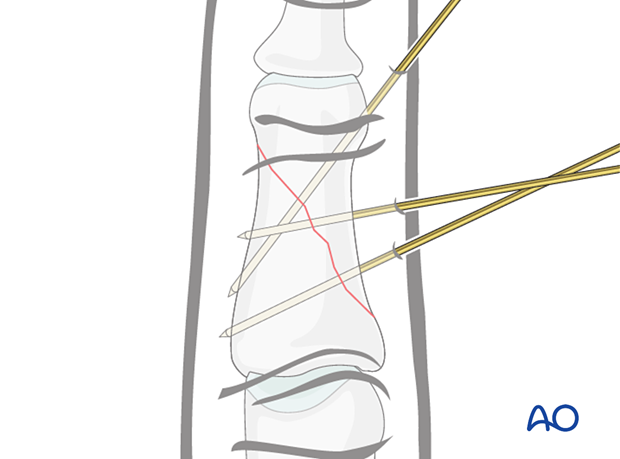 K-wire fixation of middle phalangeal shaft fracture, showing wire insertion, avoiding tendons, and confirming reduction.