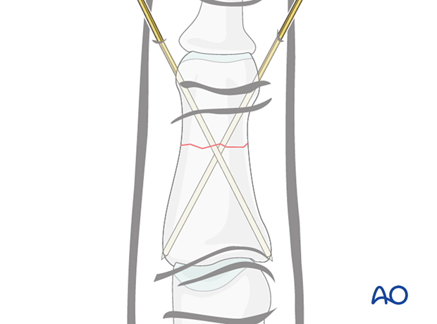 K-wire fixation of middle phalangeal shaft fracture, showing wire insertion, avoiding tendons, and confirming reduction.