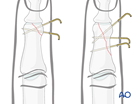 K-wire fixation of a partial articular fracture of the middle phalangeal head