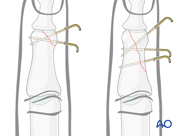 K-wire fixation of partial articular fracture, showing wire insertion for stabilization, reduction methods, and risks.