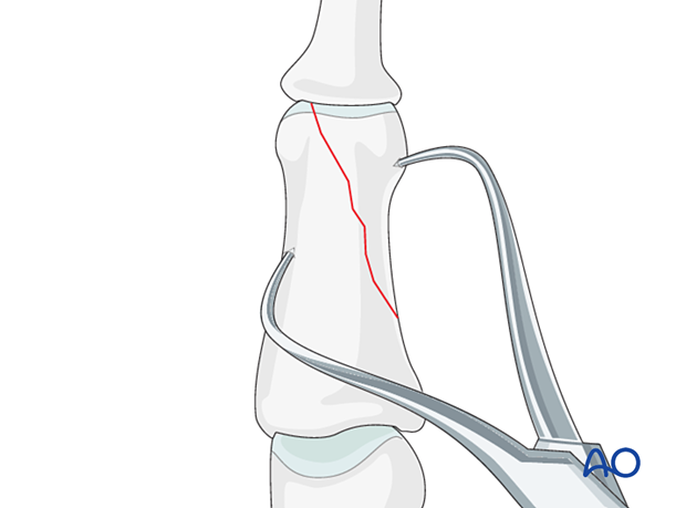 K-wire fixation of partial articular fracture, showing open reduction, lag screw fixation, and extensor apparatus interposition.