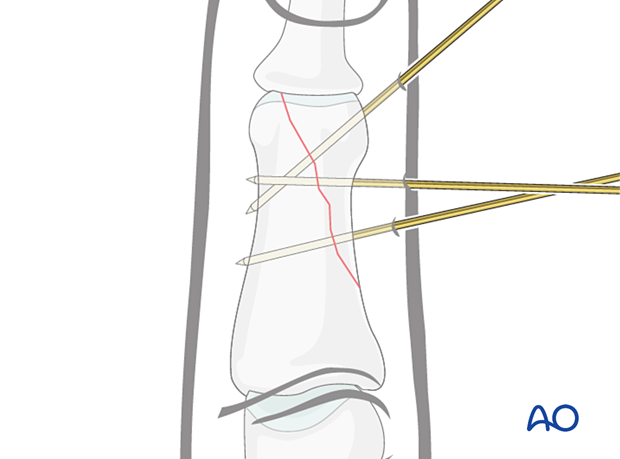 K-wire fixation of partial articular fracture, showing wire insertion, avoiding tendons, and confirming reduction.