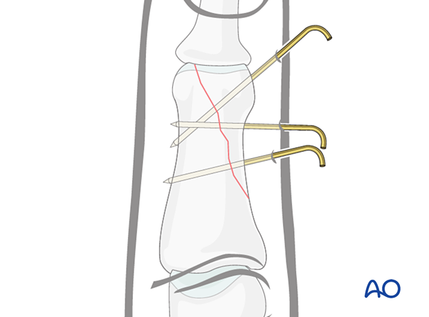 K-wire fixation of partial articular fracture, showing wire ends bent for skin protection and swelling accommodation.