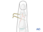 K-wire fixation of a complete articular fracture of the middle phalangeal head