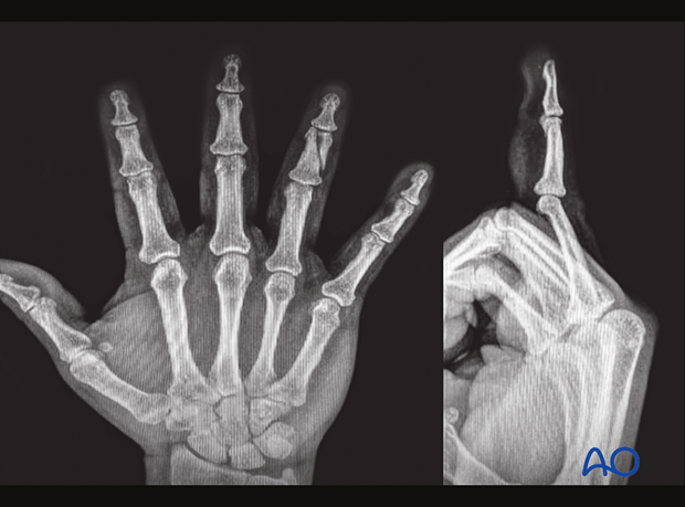 74_X010_i090 These x-rays show an articular fracture of the 4th middle phalangeal head with extension in the shaft.