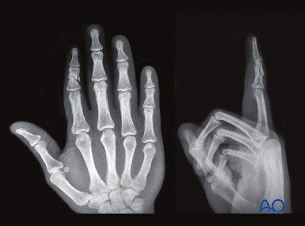 Complications of middle phalangeal injury management: signs of nonunion include pain and nonbridging healing on x-ray or CT after 6–9 months.