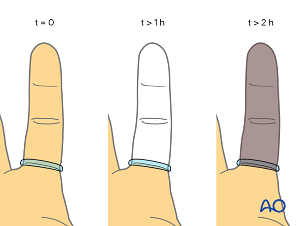 Complications of middle phalangeal injury management: ensure removal of glove tourniquet post-surgery to prevent ischemia and finger loss.