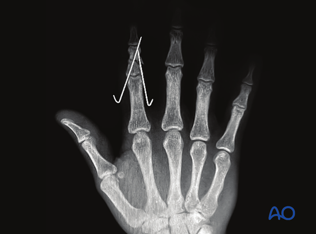 Complications of middle phalangeal injury management: postoperative AP x-ray shows index finger shaft fracture incompletely stabilized with two K-wires, lacking resistance to rotational displacement.