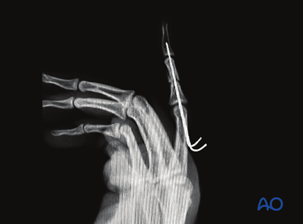 Complications of middle phalangeal injury management: lateral x-ray.