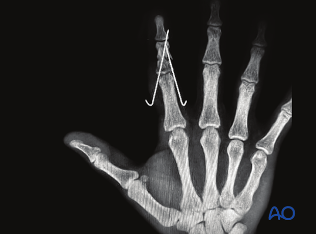 Oligotrophic nonunion of a middle phalangeal fracture treated with K-wire fixation