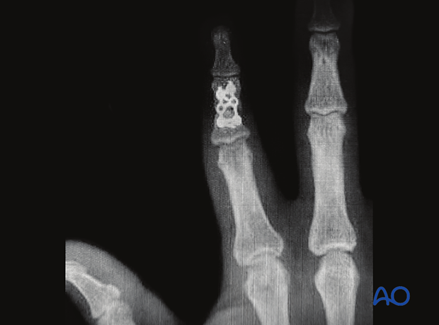 Complications of middle phalangeal injury management: AP x-ray after revision surgery with strut plate fixation shows achieved axial alignment and rotational correction.