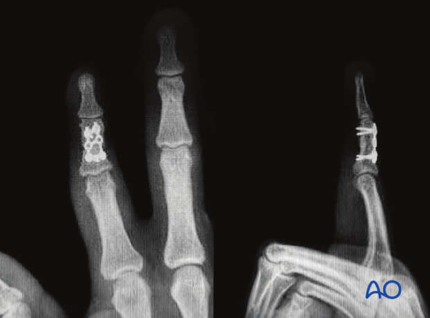 Complications of middle phalangeal injury management: AP and lateral x-rays of the healed fracture.