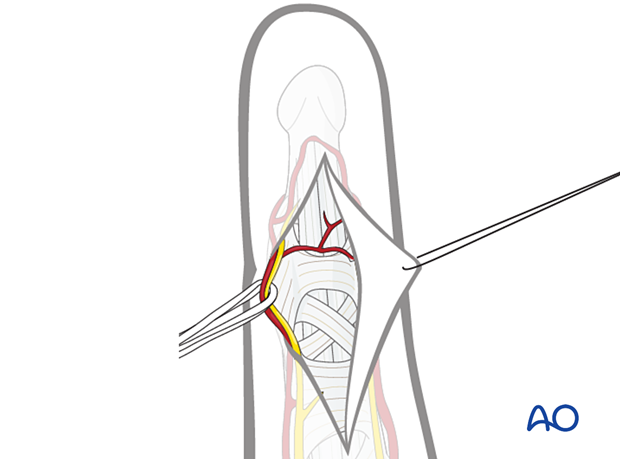 Mobilized digital arteries and nerves during the dorsal approach to the DIP joint