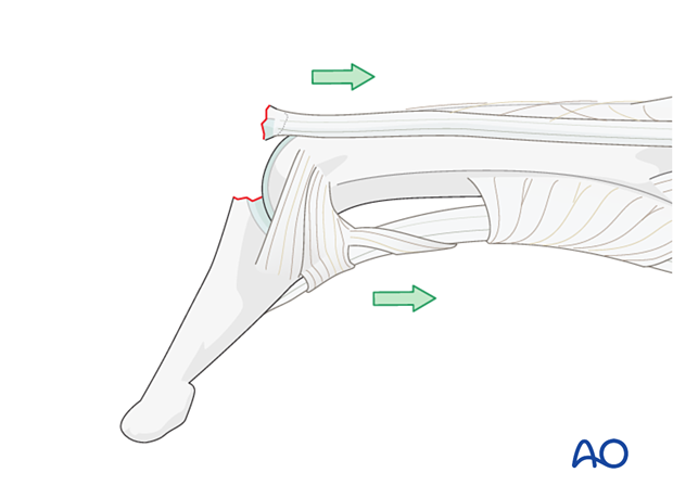 Forces (flexion injury) leading to a dorsal avulsion injury