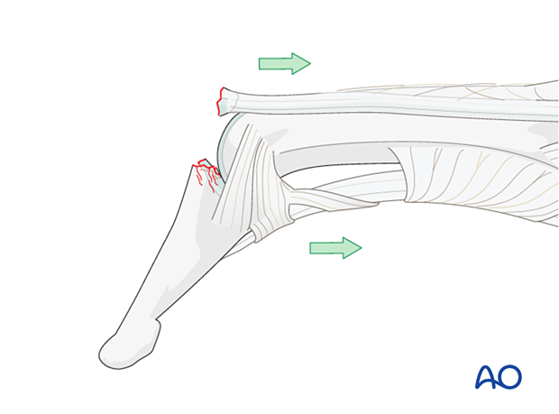 Forces (axial compression injury) leading to a dorsal avulsion injury