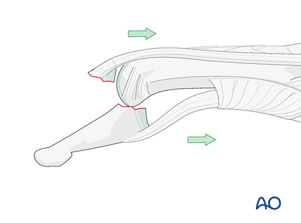 Forces leading to DIP joint subluxation and a dorsal avulsion injury
