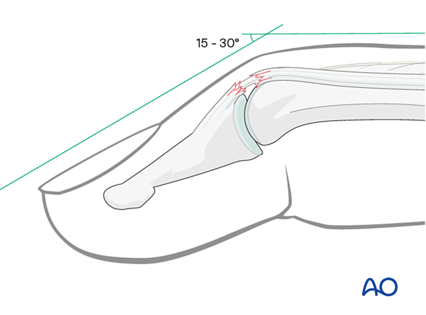 Partial disruption of the extensor tendon at the DIP joint