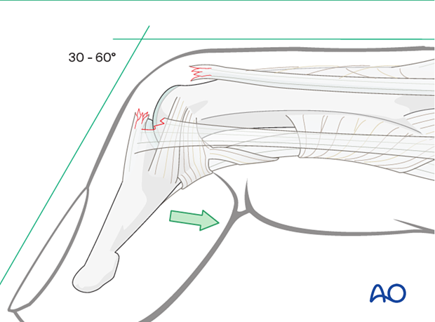 Disruption of the central part of the extensor mechanism at the DIP joint