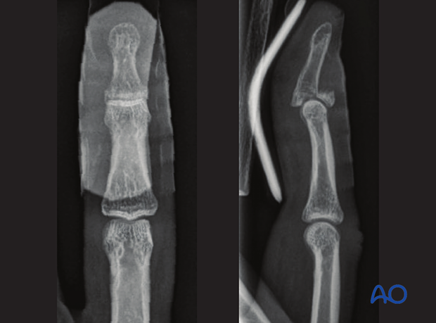 AP and lateral x-ray showing a bony dorsal avulsion of the distal phalanx of a finger