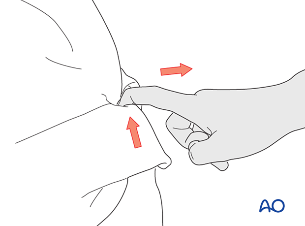 Hyperextension and strong pull on the flexor tendon causing a palmar avulsion of the distal phalangeal base