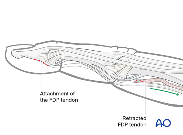 Retracted flexor digitorum profundus after avulsion injury