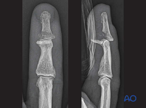 AP and lateral x-rays of a palmar avulsion fracture of the distal phalangeal base