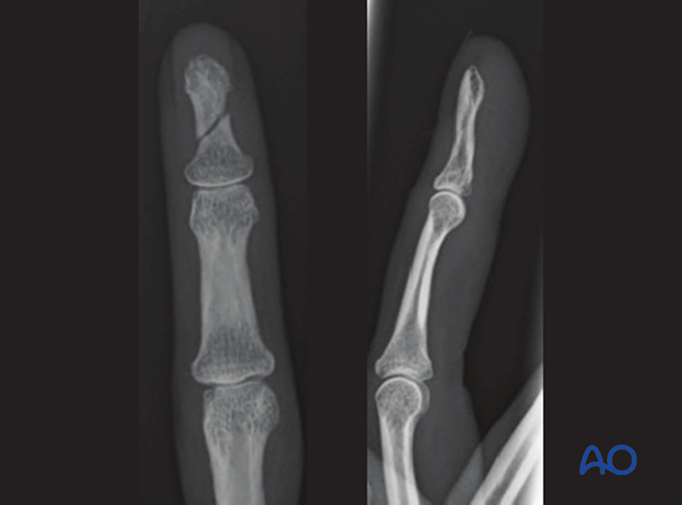 AP and lateral x-ray of an oblique fracture of the distal phalangeal shaft