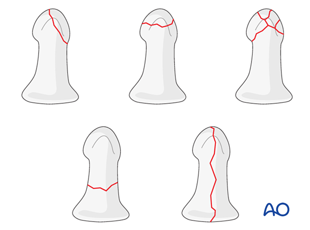 Fracture pattern in the distal phalanx after Schneider