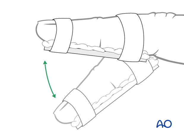 Immobilization of the DIP joint with a palmar splint