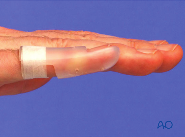 Contoured custom thermoplastic splint to immobilize the DIP joint